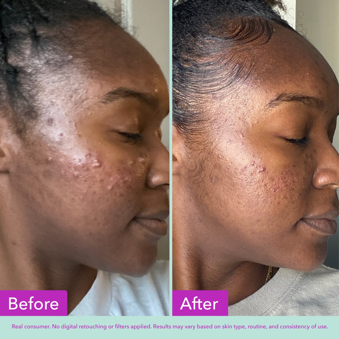 acne-foaming-cleanser-w2 zb_p.jpg