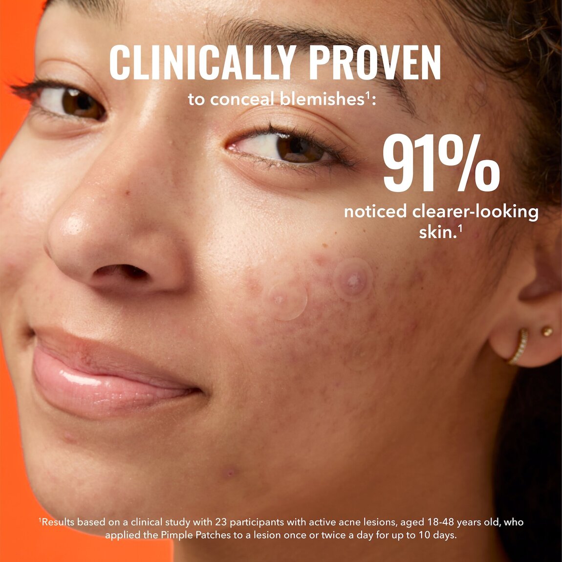 pimple-patches-y0 zb_p.jpg