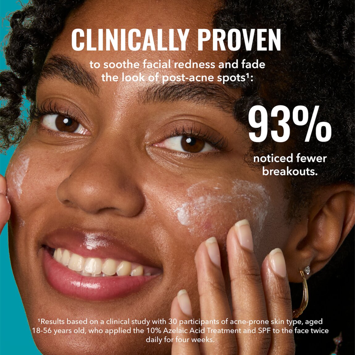 10-azelaic-acid-treatment-a0 zb_p.jpg